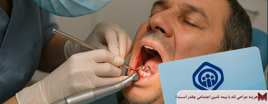 هزینه جراحی لثه با بیمه تامین اجتماعی چقدر است؟