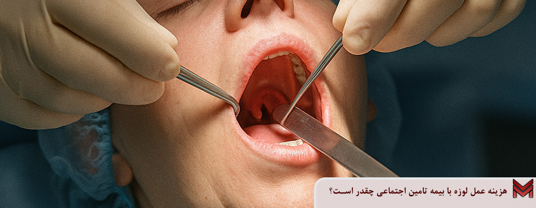 هزینه عمل لوزه با بیمه تامین اجتماعی چقدر است؟
